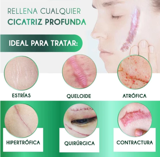 RENOVA MAX™- ¡NUEVO! Crema anti cicatrices